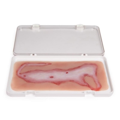 Erler-Zimmer Large Scalding-Burn Wound Moulage